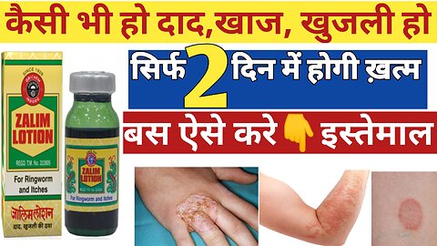 Zalim lotion uses in hindi || zaalim lotion for fungal infection