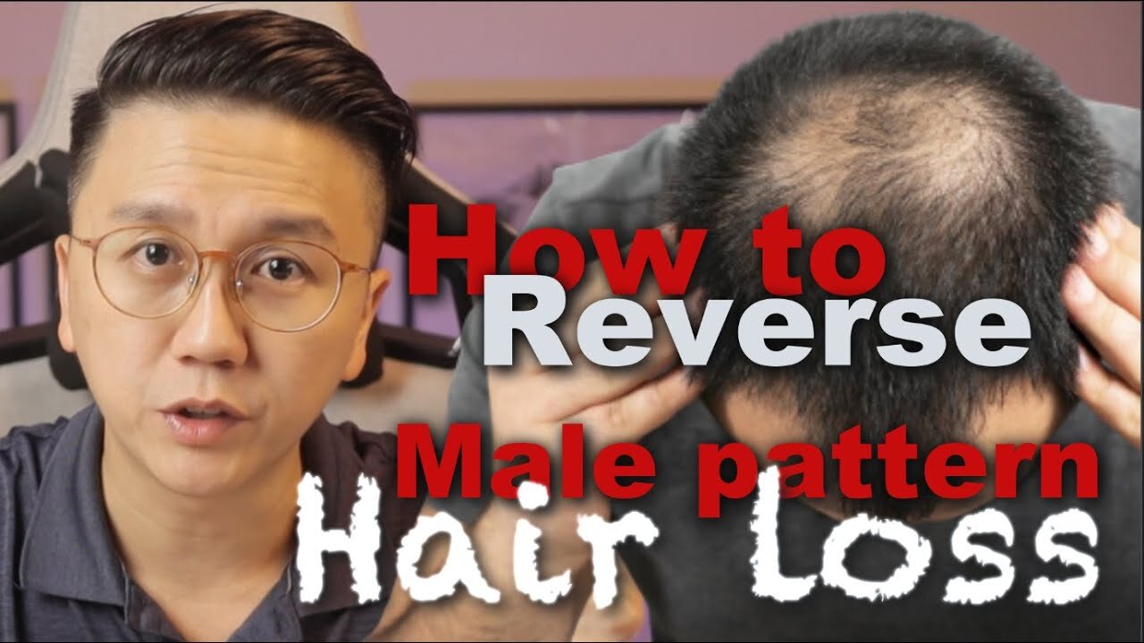 How to Reverse Male Pattern Baldness - Hair Loss in Men