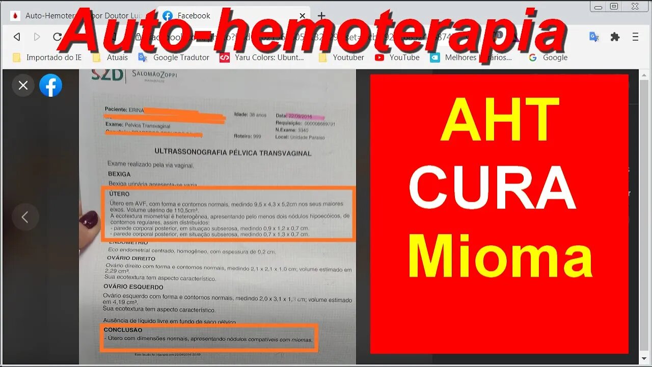 AUTO-HEMOTERAPIA ELIMINA MIOMA