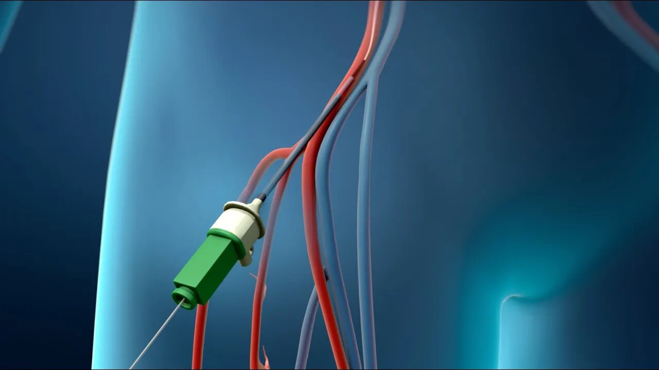 Angioplastia coronaria (Acceso femoral)