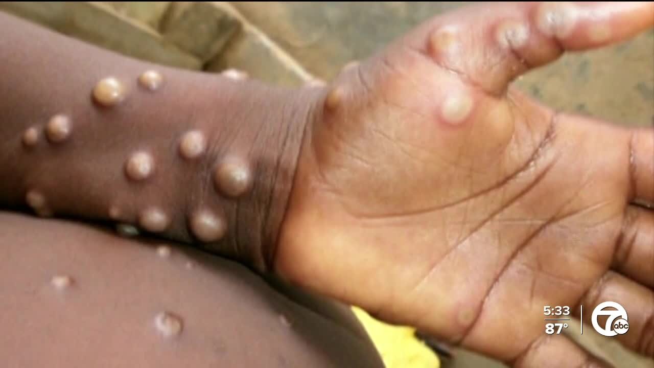 Fauci says monkeypox outbreak needs to be taken more seriously