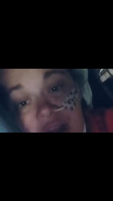 2 DAYS AFTER THE JAB HER LIFE TURNED INTO THIS - A LIVING HELL AND 19 MONTHS LATER HERE SHE IS.