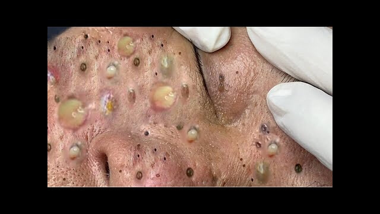 Satisfying blackhead removal, relaxing Pimple Popping 114