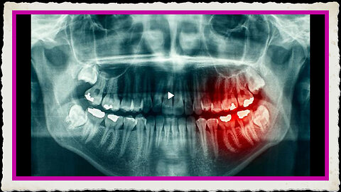 Mercury, Root Canals And Implants - Oh My! - Blanche Grube, DMD, IMD - Excellent Information