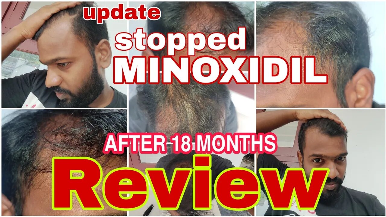 Reviewing the effect of minoxidil mintop 10 after 18 months from the day i stopped using it...Resul