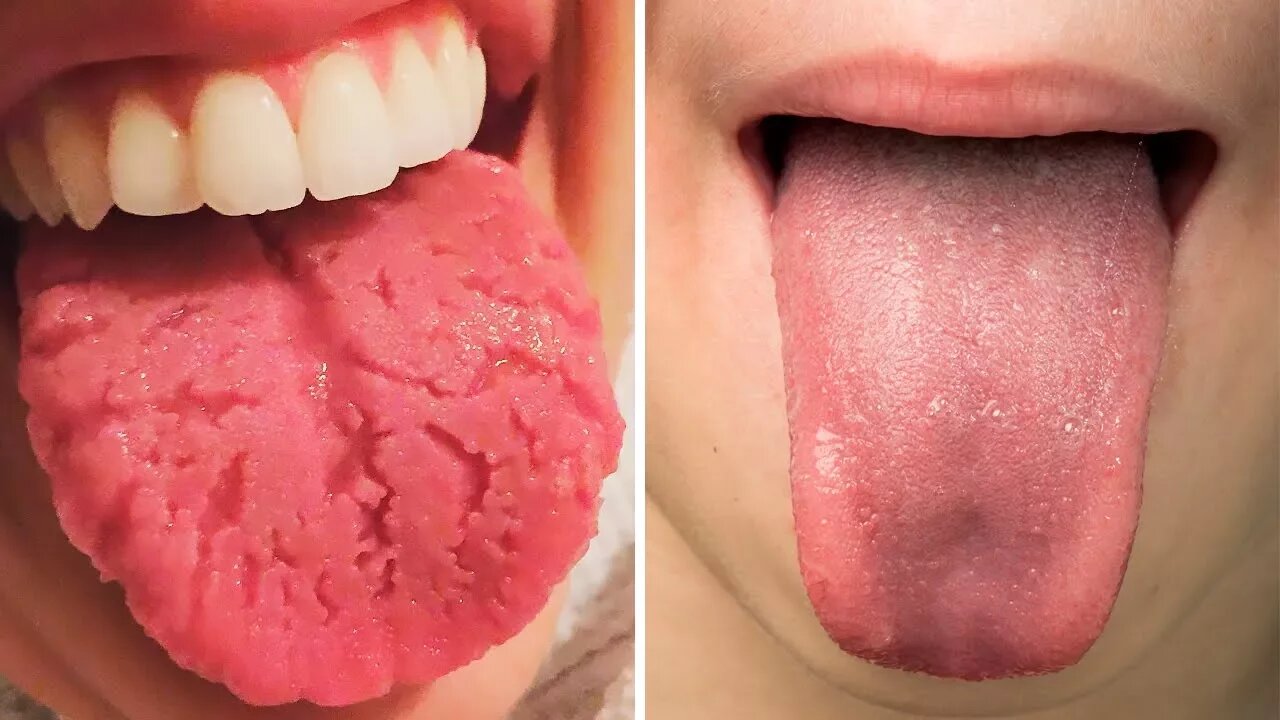 What Your Tongue Says About Your Health