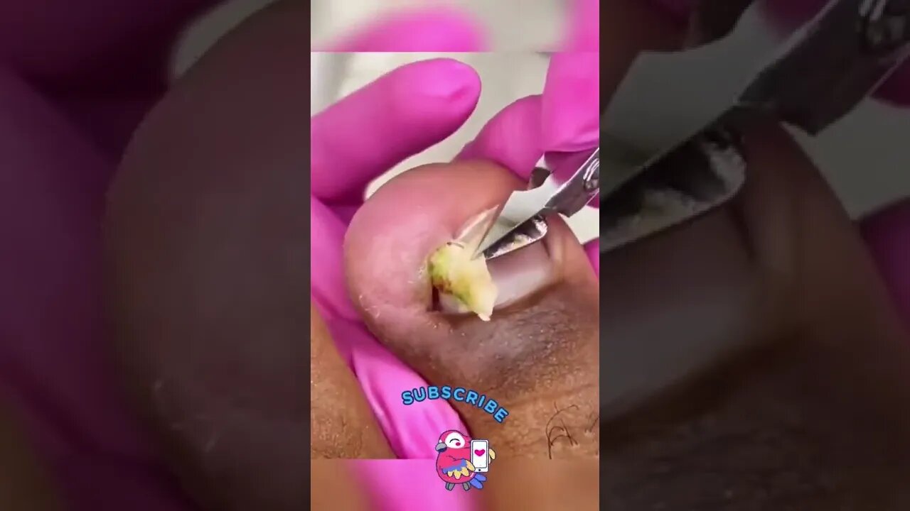 Disgusting Toe Nail Removal By Professional BlackHead