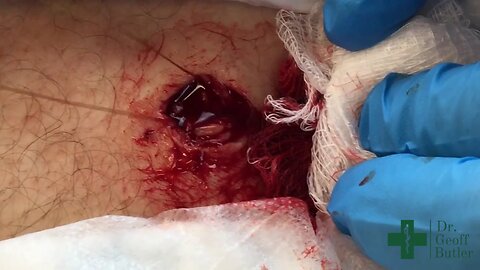 Removal of an Epidermal cyst on the upper leg