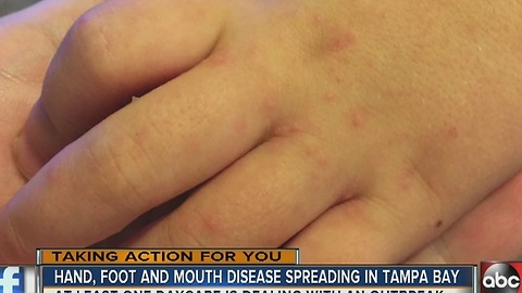 Hand, Foot and Mouth Disease concerns growing in Tampa Bay area