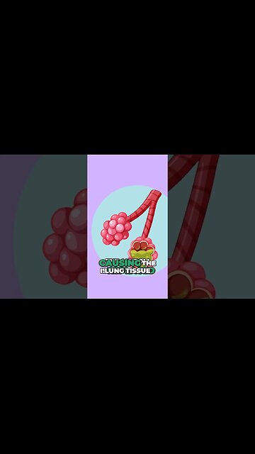 What is Lung Consolidation? 🫁💦