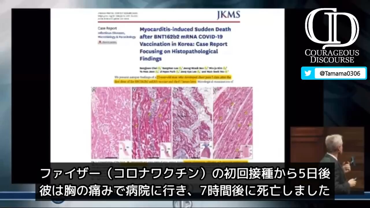 【コロワク】接種後死亡者の心臓は炎症だらけ