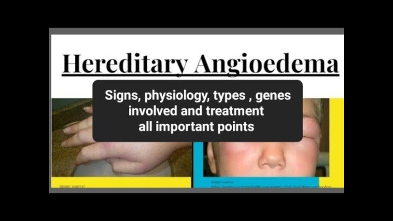 Hereditary Angioedema