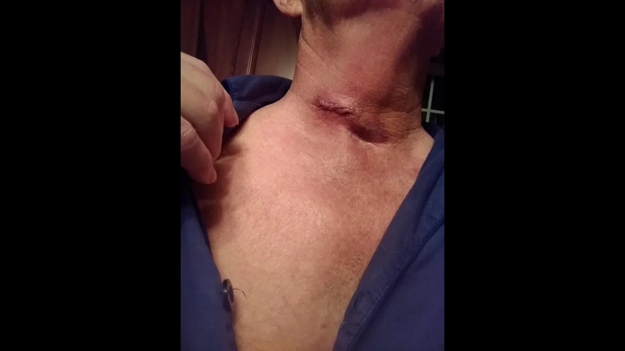 7 Day 3 ACDF surgery recovery