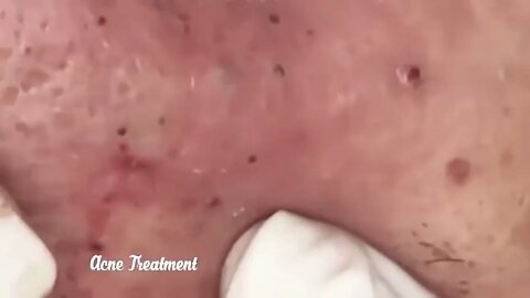 Satisfactory Video Blackhead Removal Skin Cleansing #4 | 2022 Video