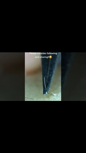 Double Ingrown Hair Removal