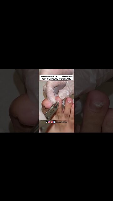 TRIMMING & CLEANING OF FUNGAL TOENAIL 2023 [ SATISFYING ] BY FOOT DOCTOR MISS FOOT FIXER