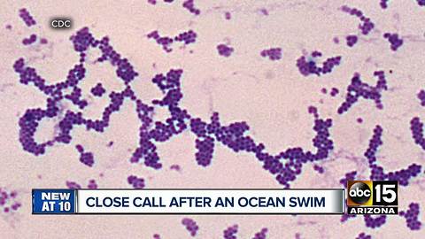 Phoenix man survives beach infection while in San Diego