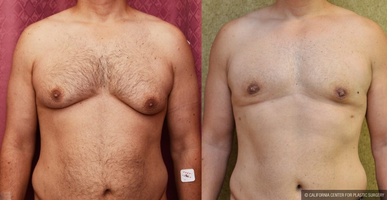 How to get rid of Man Boobs? Workout and Diet Tips