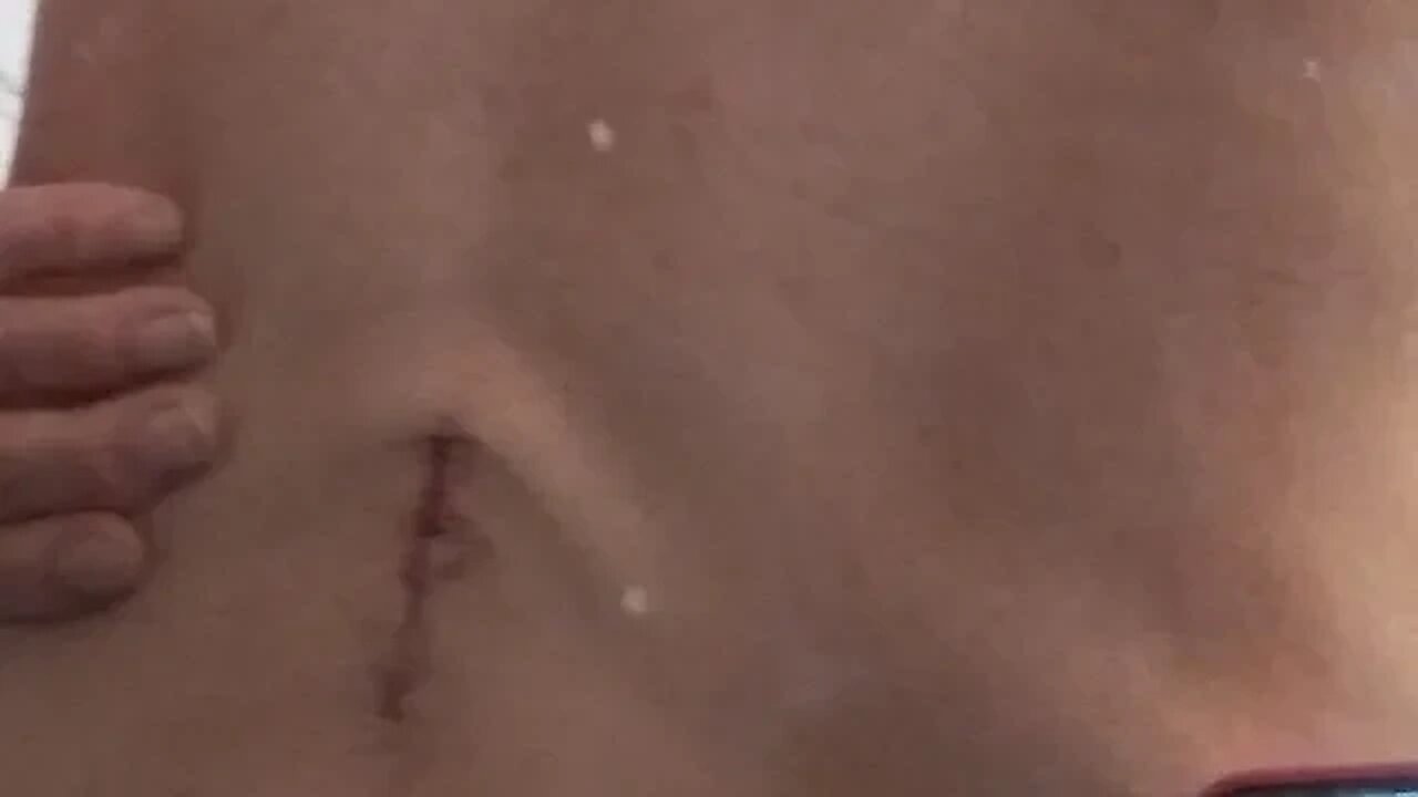 2 Back surgery