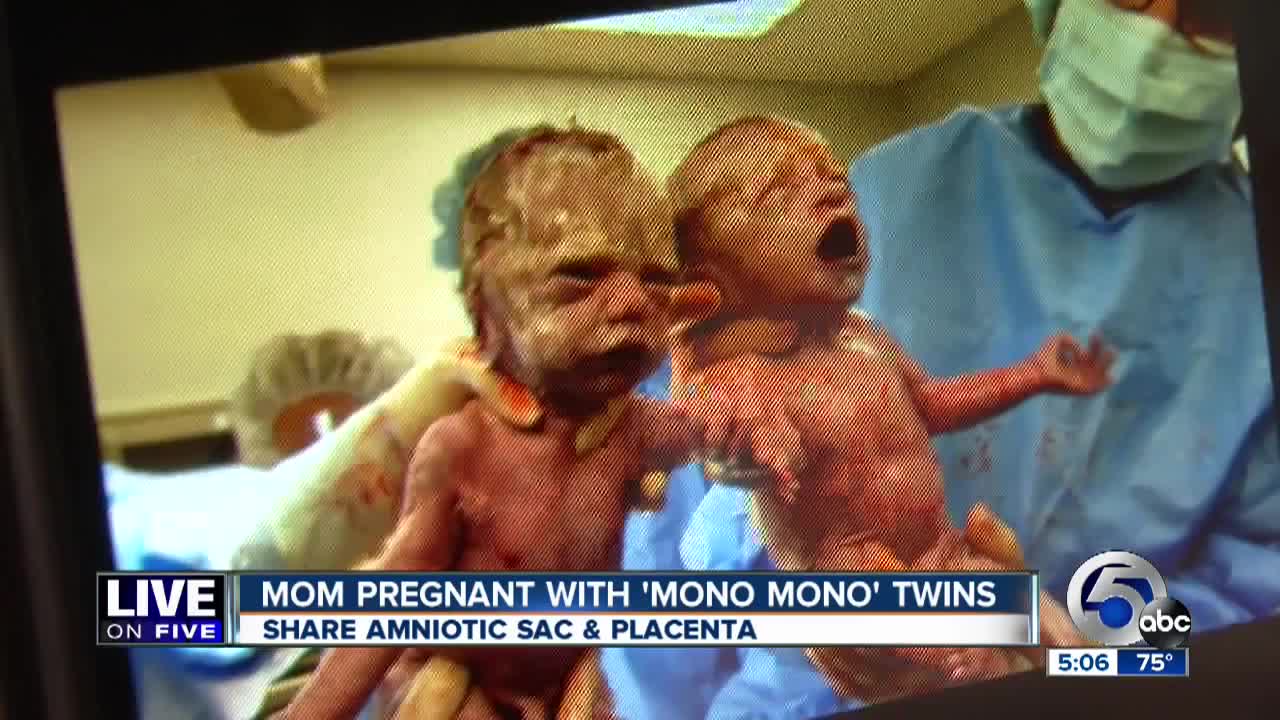 FLASHBACK: Rare mono mono twins born holding hands