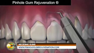 New procedure for receding gums