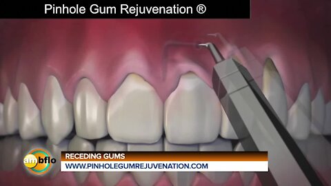 New procedure for receding gums
