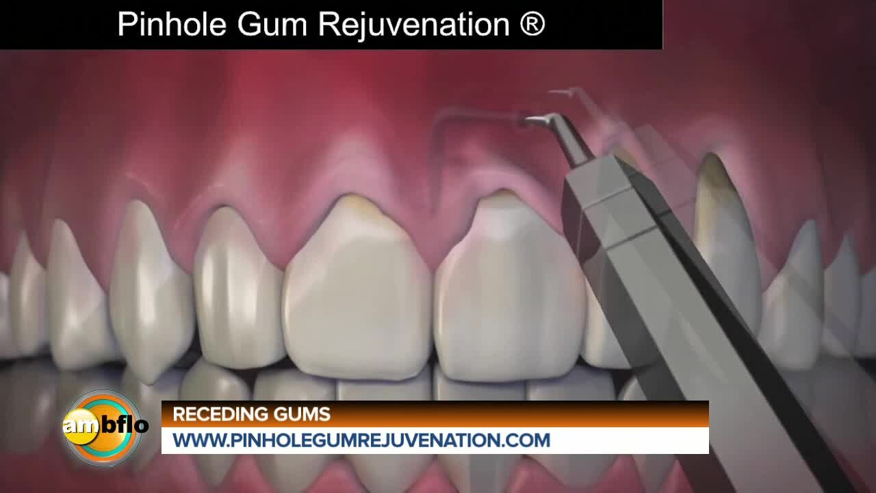 New procedure for receding gums
