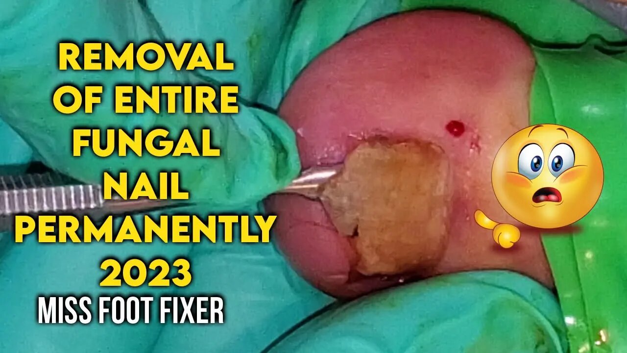 REMOVAL OF ENTIRE FUNGAL NAIL PERMANENTLY 2023 BY FAMOUS PODIATRIST MISS FOOT FIXER