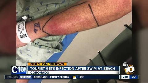 Man claims he contracted infection swimming off Coronado