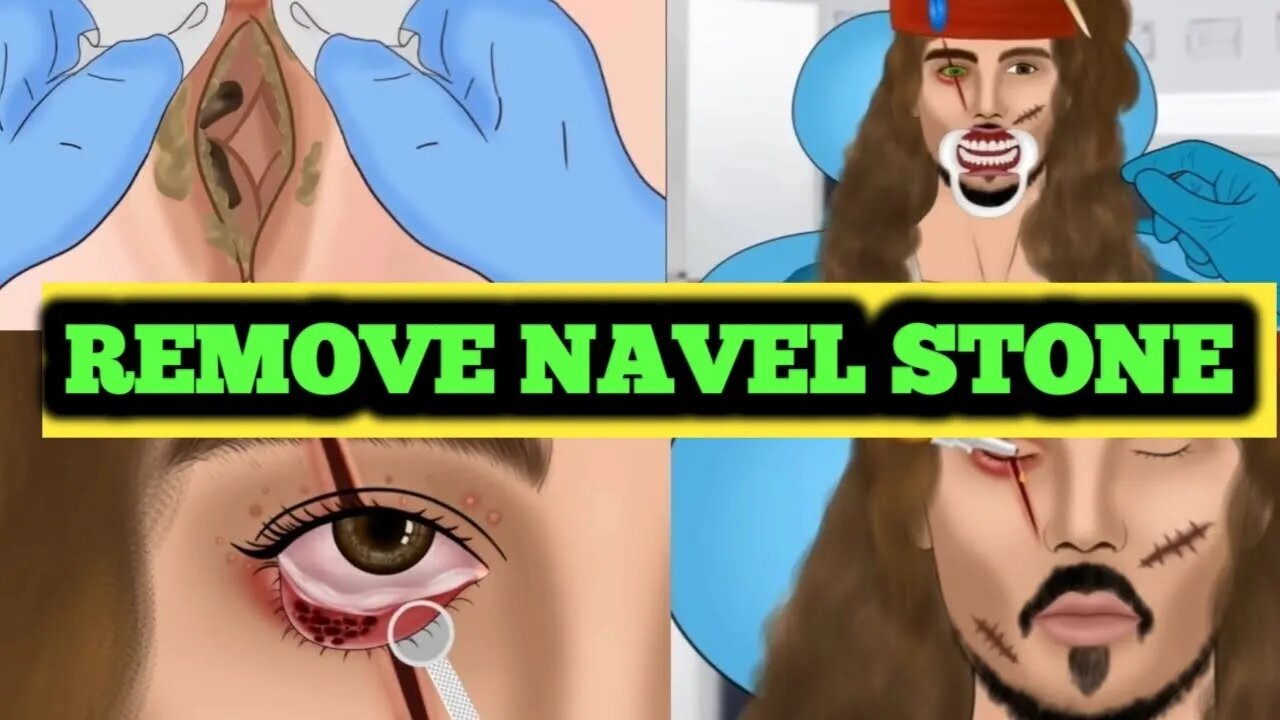 ASMR animation Removing Huge Navel Stone/relaxing asmr animations video2023july...@uttam6361