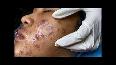 Compilation of the most horror acne squeezing #1