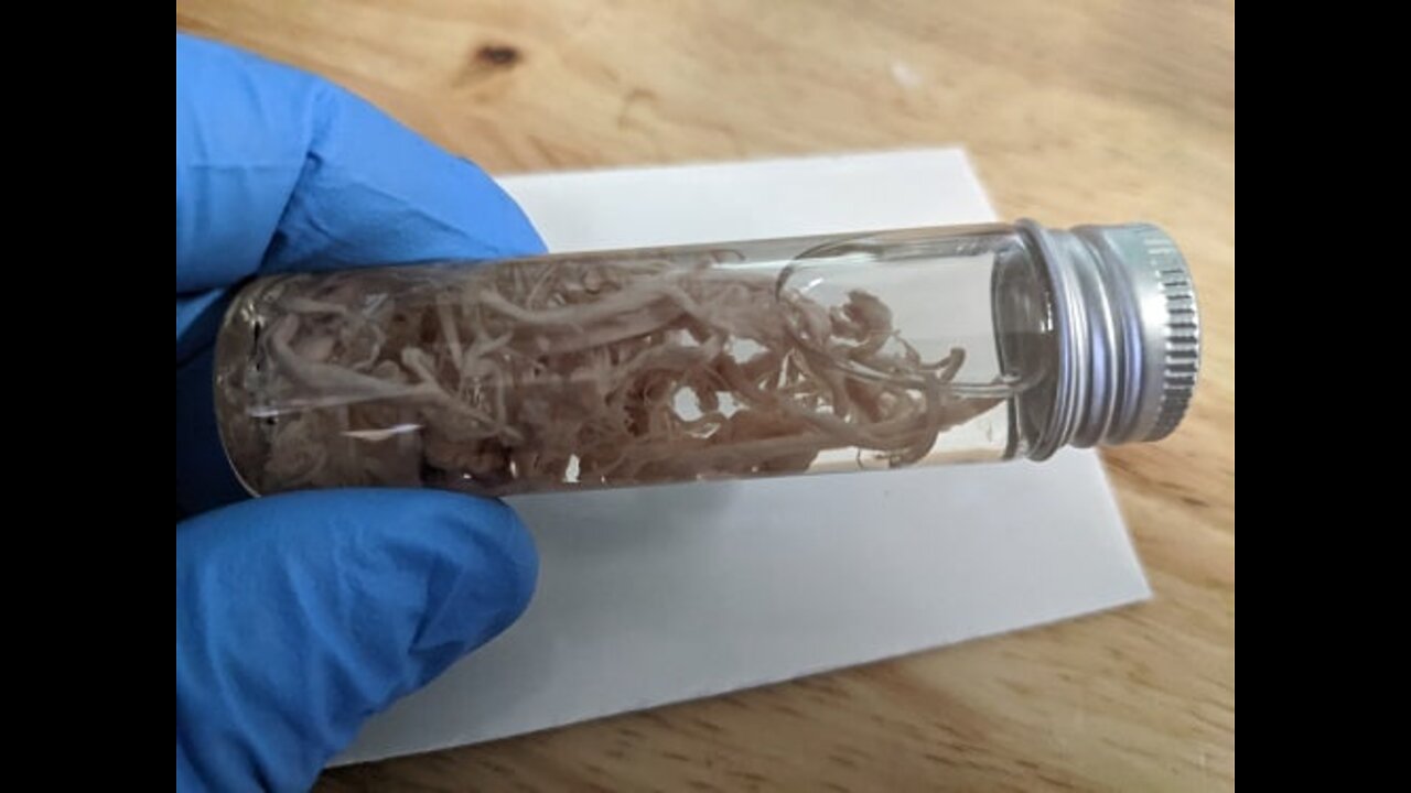 Blood clot removed from a beating heart in a fully vaccinated patient.