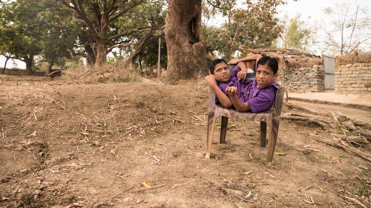 World Famous Conjoined Twins Turn 18 | BORN DIFFERENT