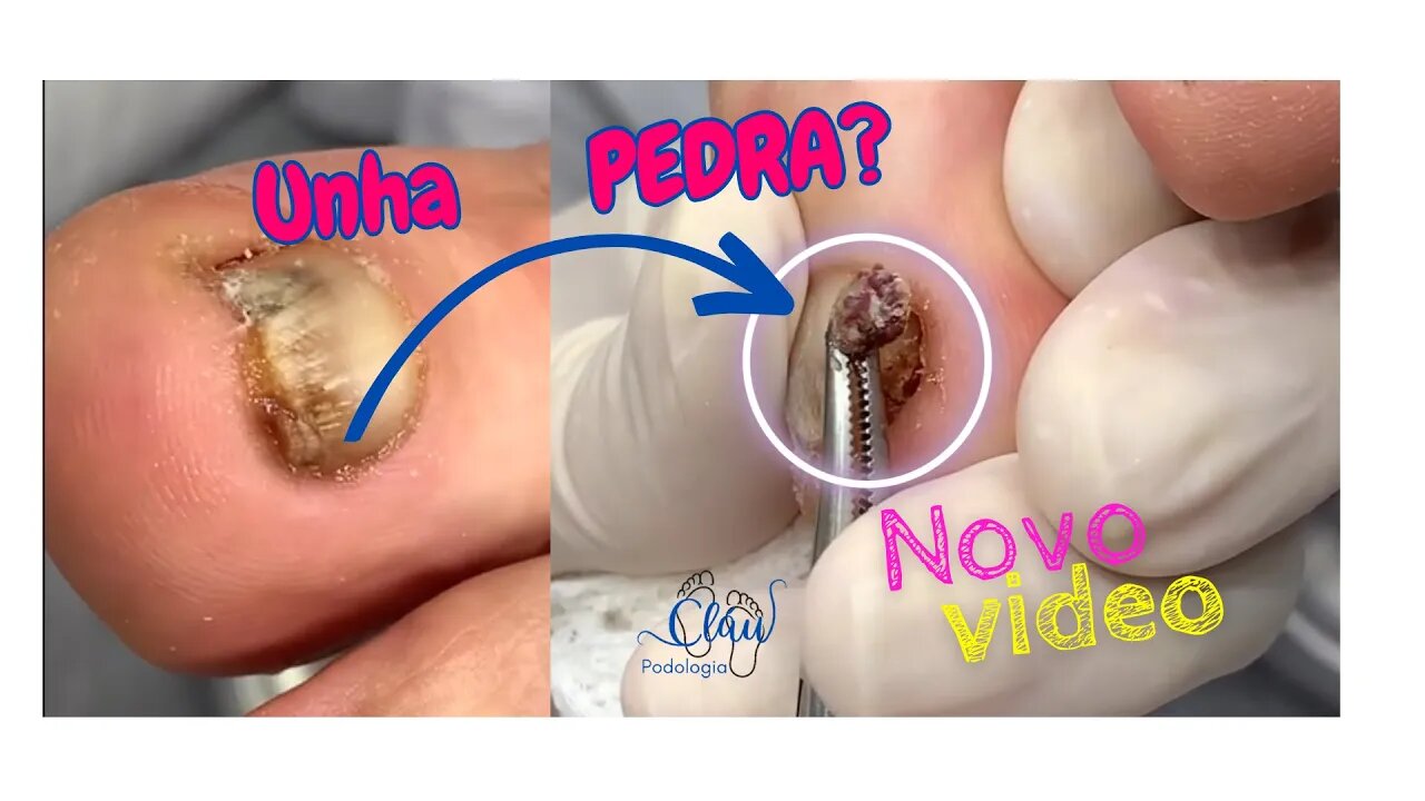 Remoçao de pedaço de UNHA muito dolorida #unhas #pes #dor #podologia #unhaencravada #procedimento