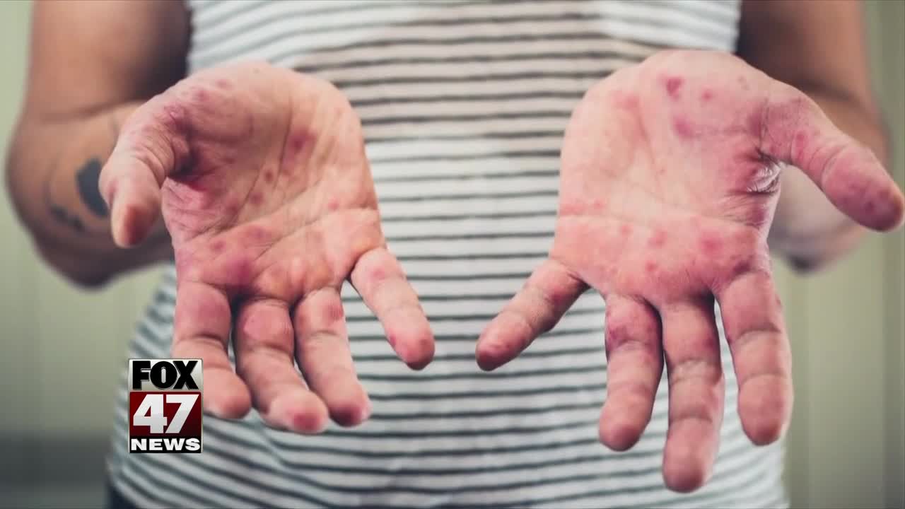 Officials: 8 measles cases in Oakland County since March 13