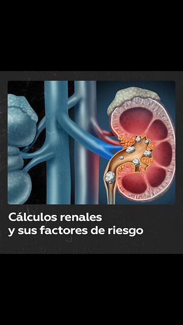 ¿Por qué salen piedras en el riñón?: síntomas y causas