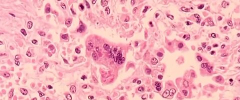 CDC now tracking 1,200 measles cases nationally, highest since 1992