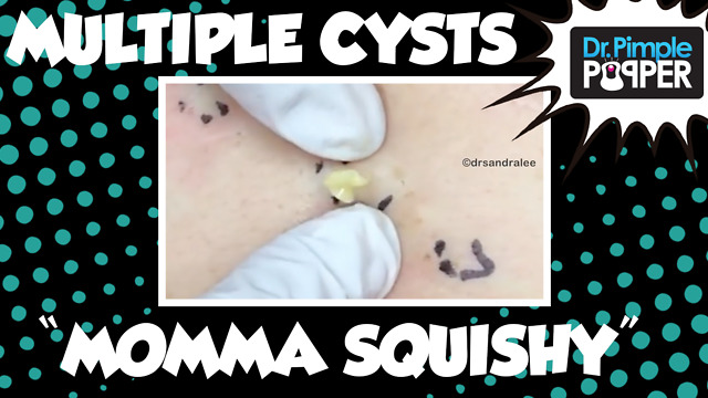 Steatocystomas & Momma Squishy! Session Five, Part 1