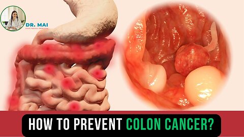 How to prevent colon cancer? | DR. MAI