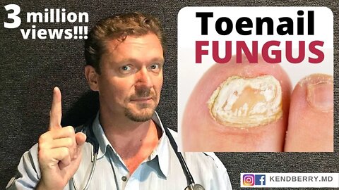 CURE Toenail Fungus (And keep it Gone FOREVER)