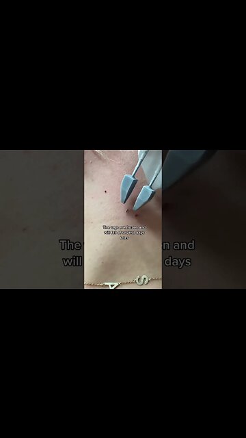 Here’s how a derm removes skin tags! #dermedplains #doctorreacts #skintag