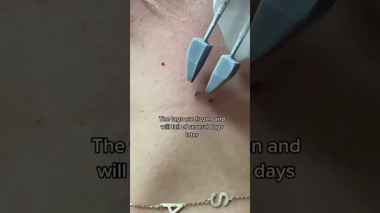 Here’s how a derm removes skin tags! #dermedplains #doctorreacts #skintag