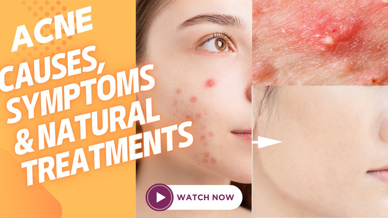 What Acne, Causes, Symptoms and Herbal Treatments | Acne | Face Fresh | herbal Treatments |