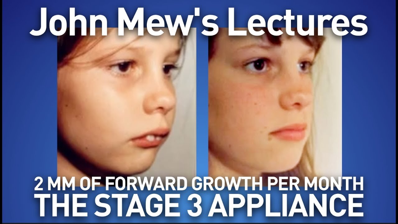 John Mew's lectures part 20: the stage 3 appliance