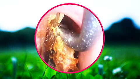 Ear Wax Removal With Clam Relaxing Music #07