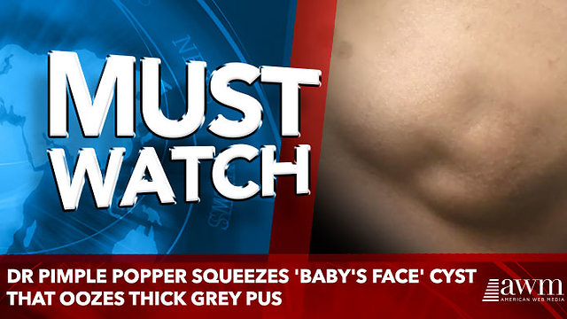 Dr Pimple Popper squeezes 'baby's face' cyst that oozes thick grey pus