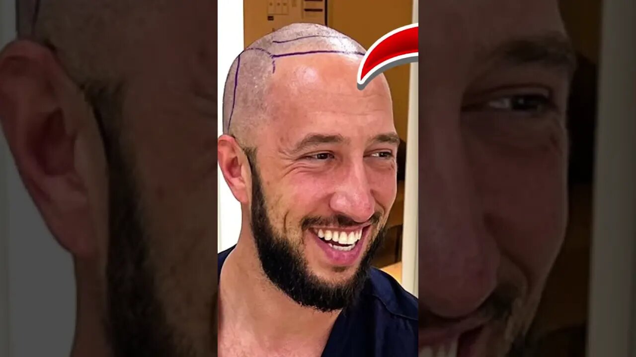 Hairline Transplant is CRAZY! #reaction #cut #funnyreaction #comedyreaction