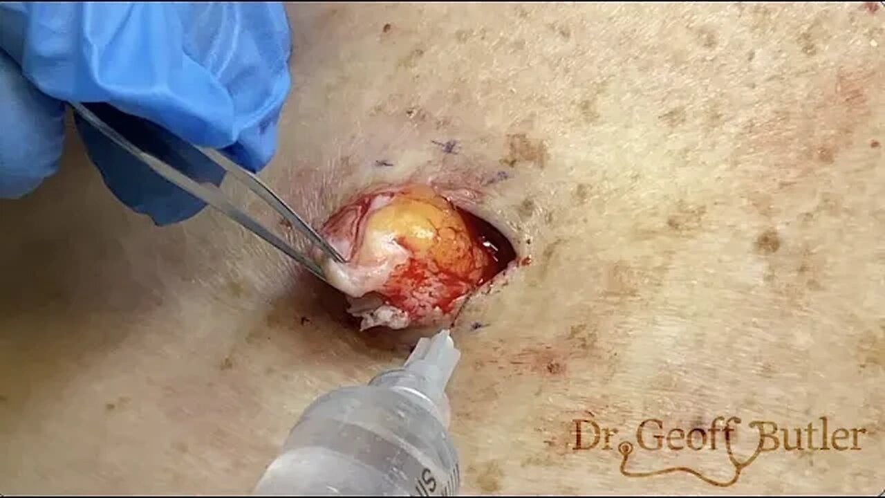 Removal of an epidermal cyst