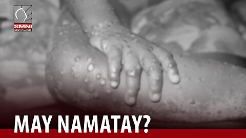 DOH, pinabulaanang may namatay na sa bansa dahil sa Mpox