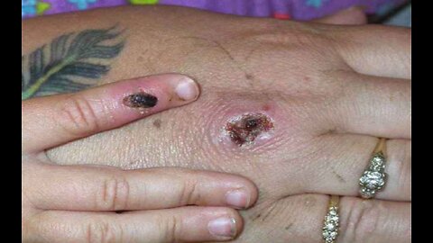 Florida Probing Possible Case of Monkeypox